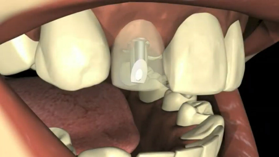 MILO 3.0mm Dental Implants