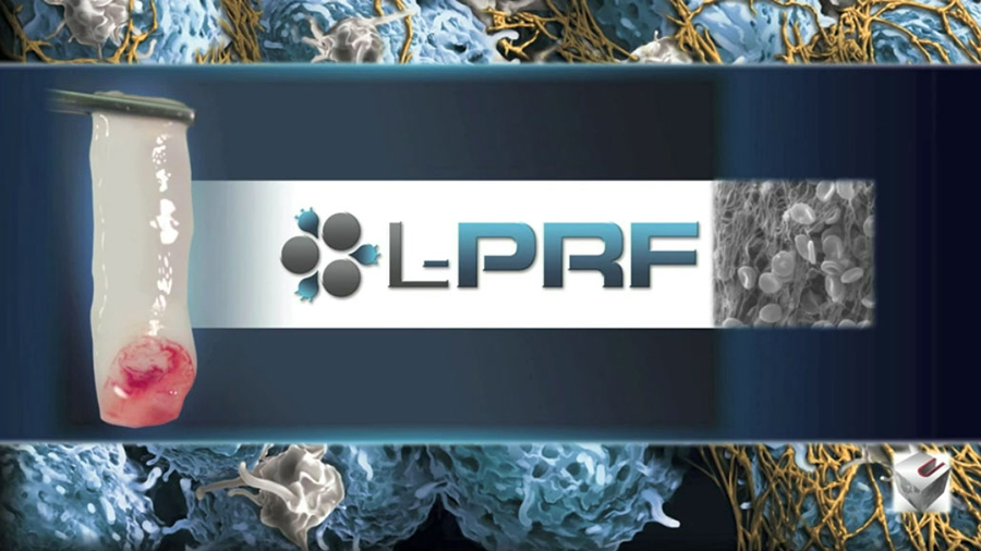 Why L-PRF (Leukocyte-Platelet Rich Fibrin)?