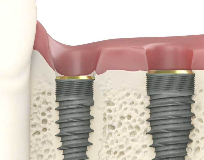 Fusion Dental Implants