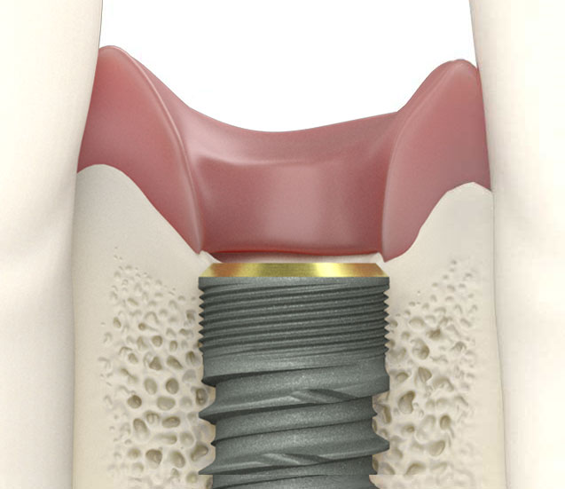 Fusion Dental Implants